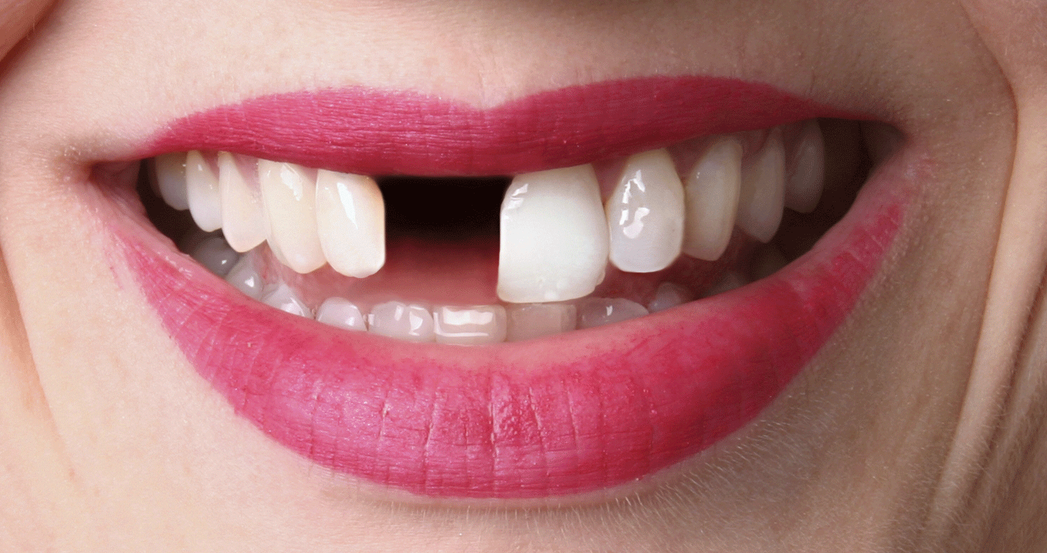 una boca que ha perdido una pieza dental. La solución pasa por someterse a un procedimiento de implante dental.