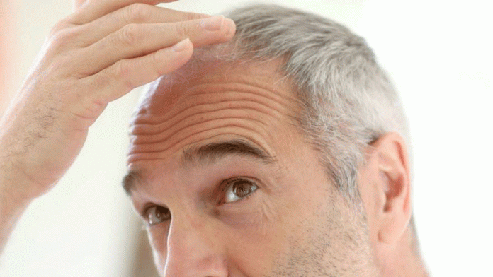 trasplante-pelo un hombre tocándose la cabeza tras un trasplante de pelo.