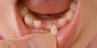 Los dientes de leche pueden contener gran cantidad de células madre.